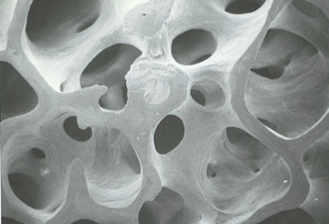 Scanning electron micrograph of trabecular (spongy) bone — the porous microarchitecture that osteoporosis erodes